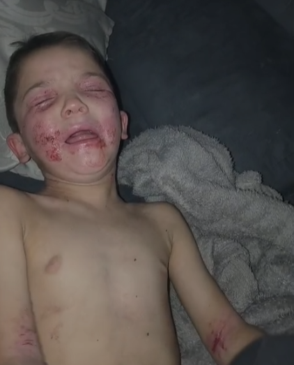 Crise grave de dermatite de Luís
